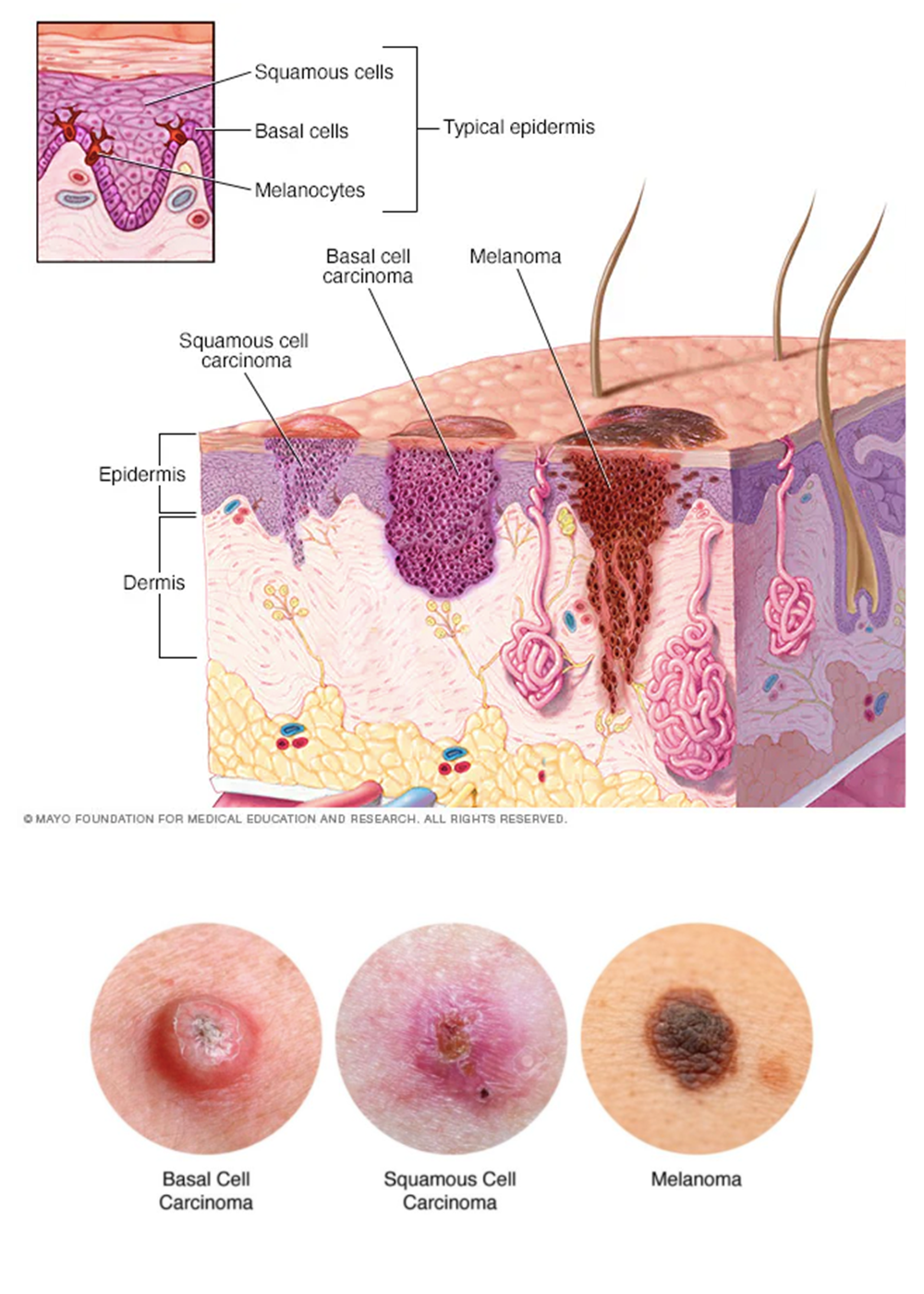 Skin Cancer Diagnosis